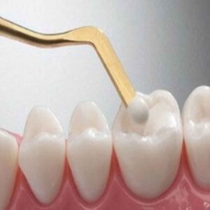 Dental Filling