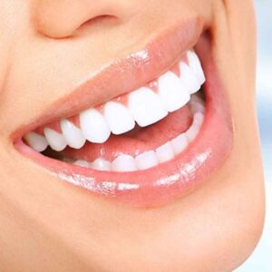 Teeth Whitening